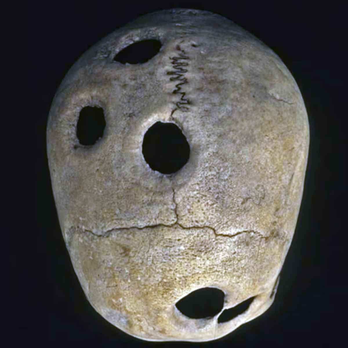 inca skull five holes trepanation