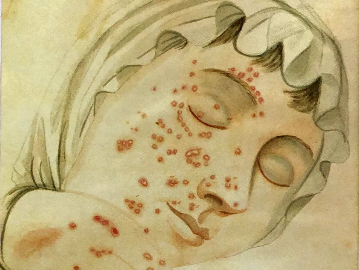 Small pox illustration